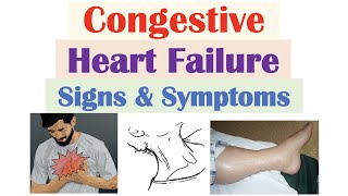 Heart Failure Symptoms and Treatments [upl. by Alarick572]