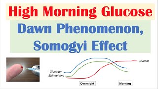 High Early Morning Glucose  Dawn Phenomenon amp Somogyi Effect [upl. by Fitzpatrick159]