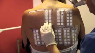 Skin Allergy Testing Using Patch Tests [upl. by Egidio]