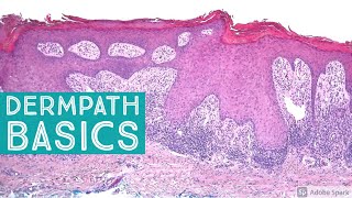 Basic Dermpath Cases  Explained by a Dermatopathologist [upl. by Hanleigh614]