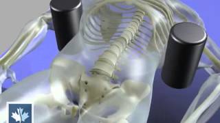 Sciatica  Spinal Decompression  Back Clinics of Canada [upl. by Llevaj281]