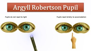 Argyll Robertson Pupil [upl. by Kinelski364]