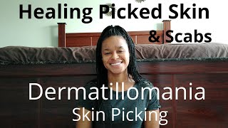 Healing Picked Skin amp Scabs  Dermatillomania [upl. by Acinet]