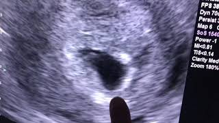 Sonogram 6 weeks pregnant [upl. by Perrins]